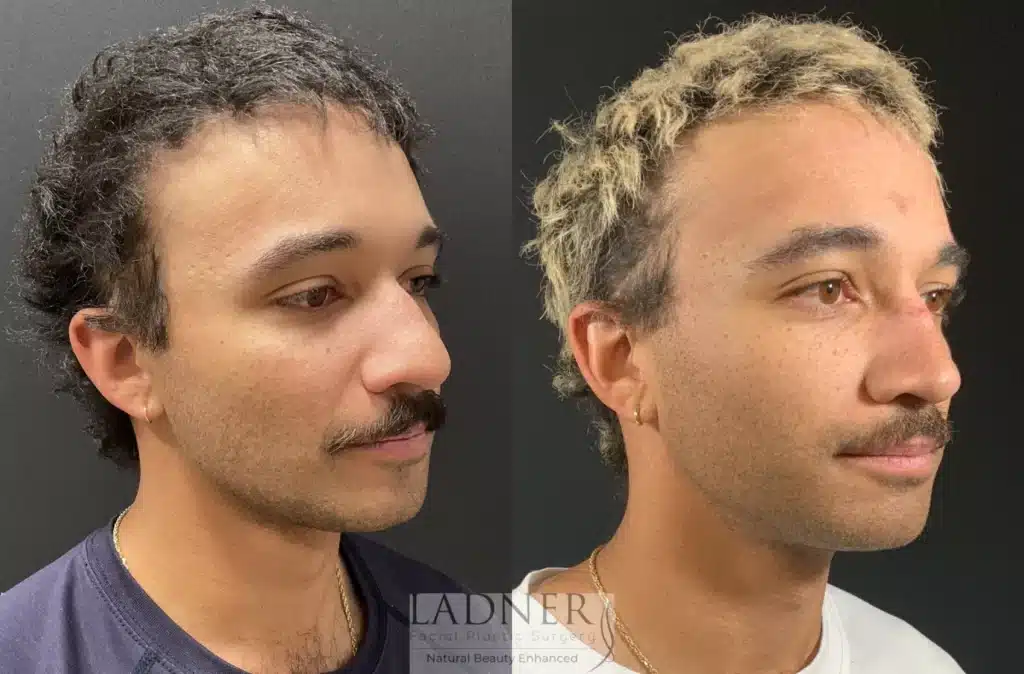 Before and After Image: Rhinoplasty - right-front-oblique