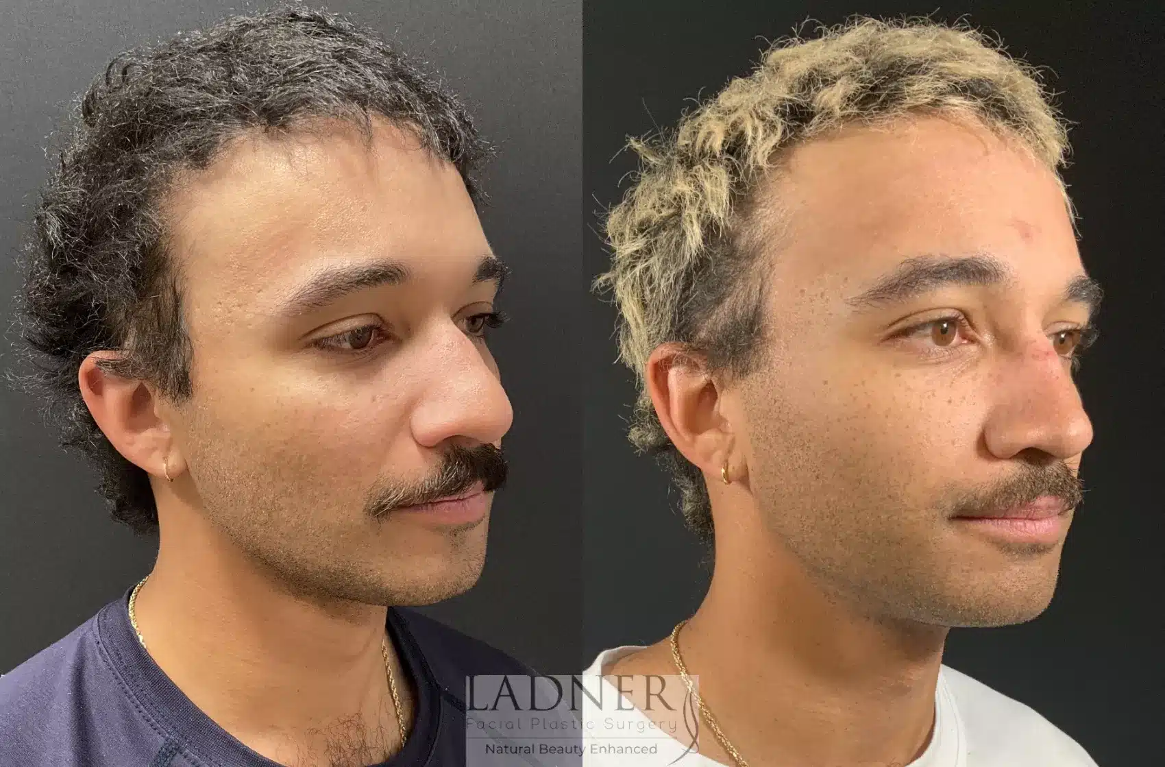 Before and After Image: Rhinoplasty - right-front-oblique