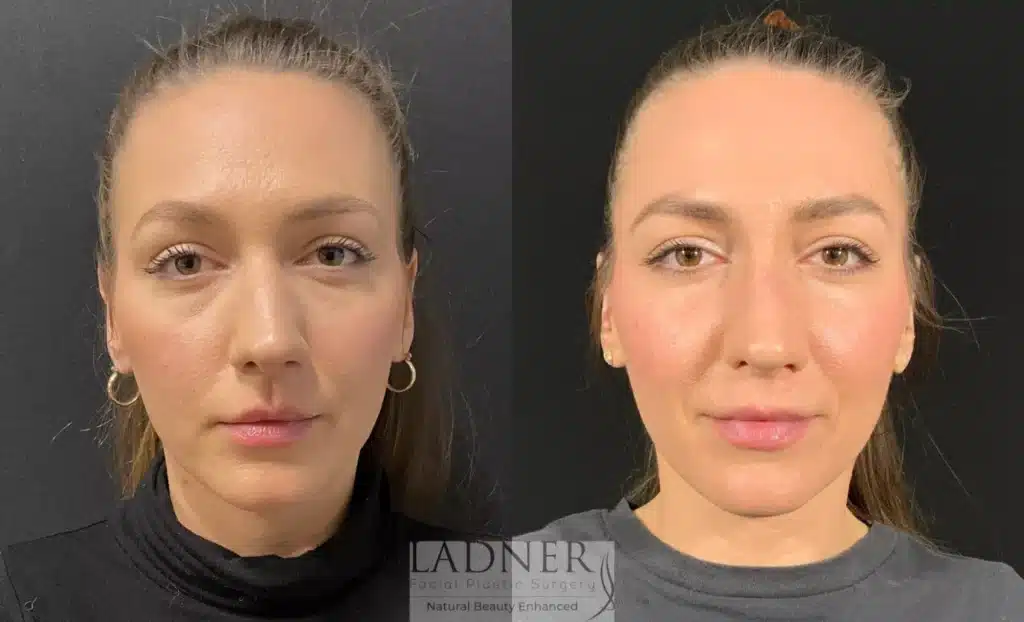Before and After Image: Rhinoplasty - front