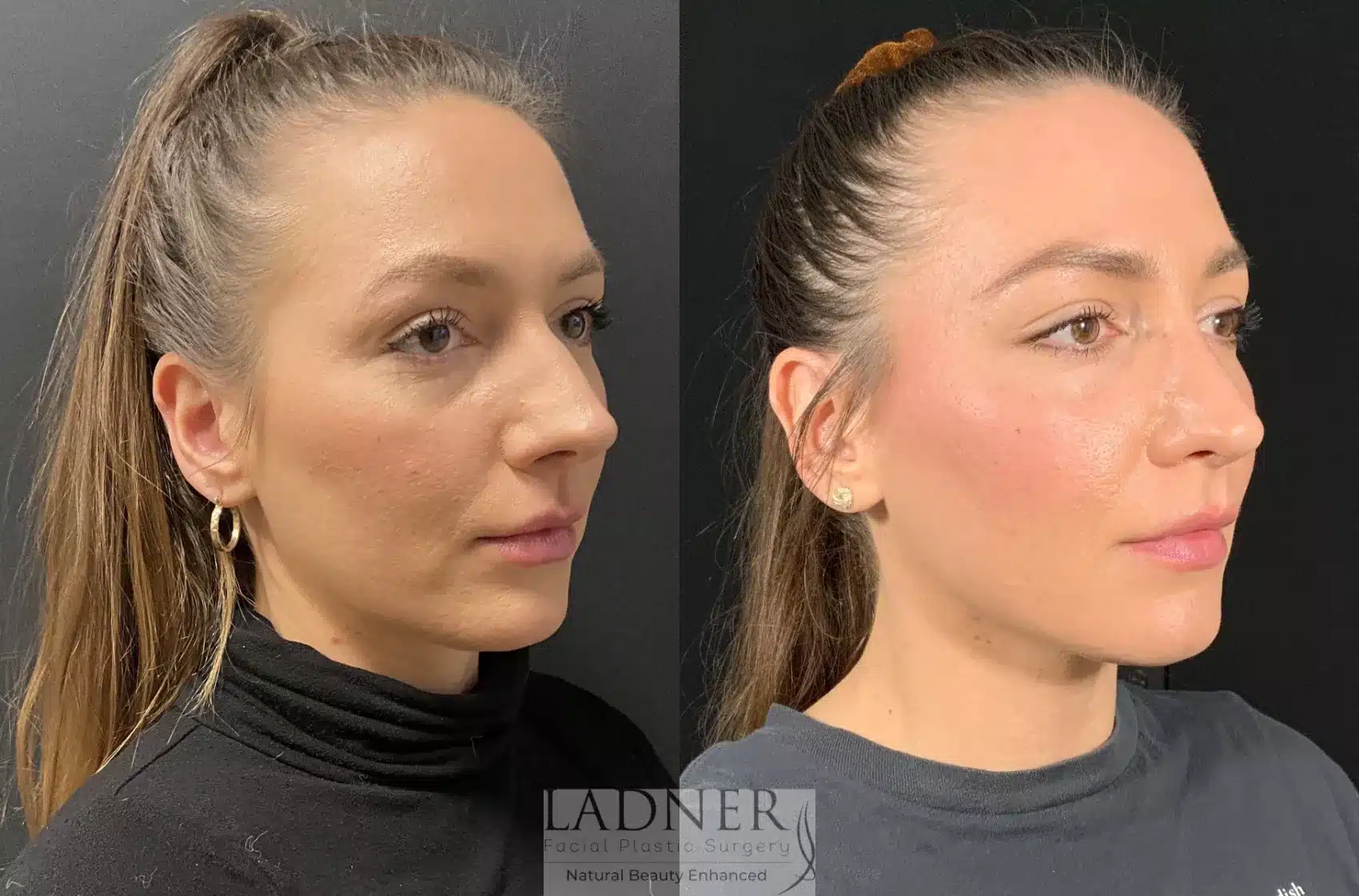 Before and After Image: Rhinoplasty - right-front-oblique