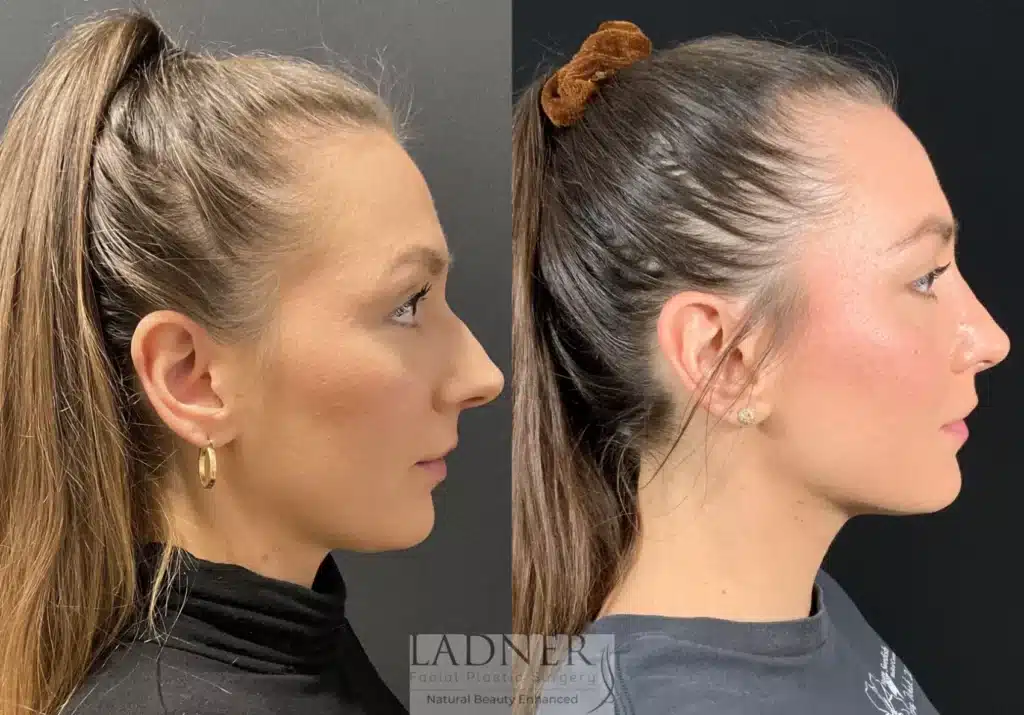 Before and After Image: Rhinoplasty - right-side