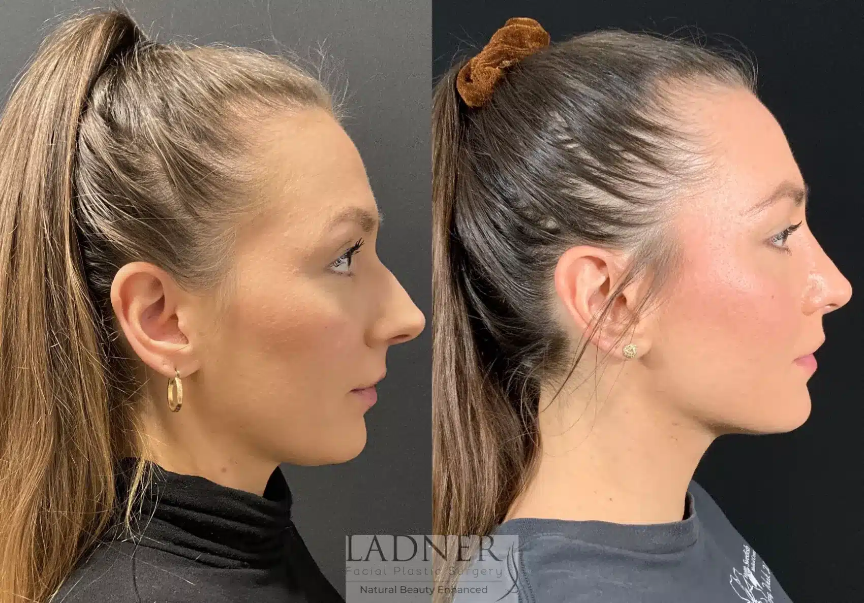 Before and After Image: Rhinoplasty - right-side