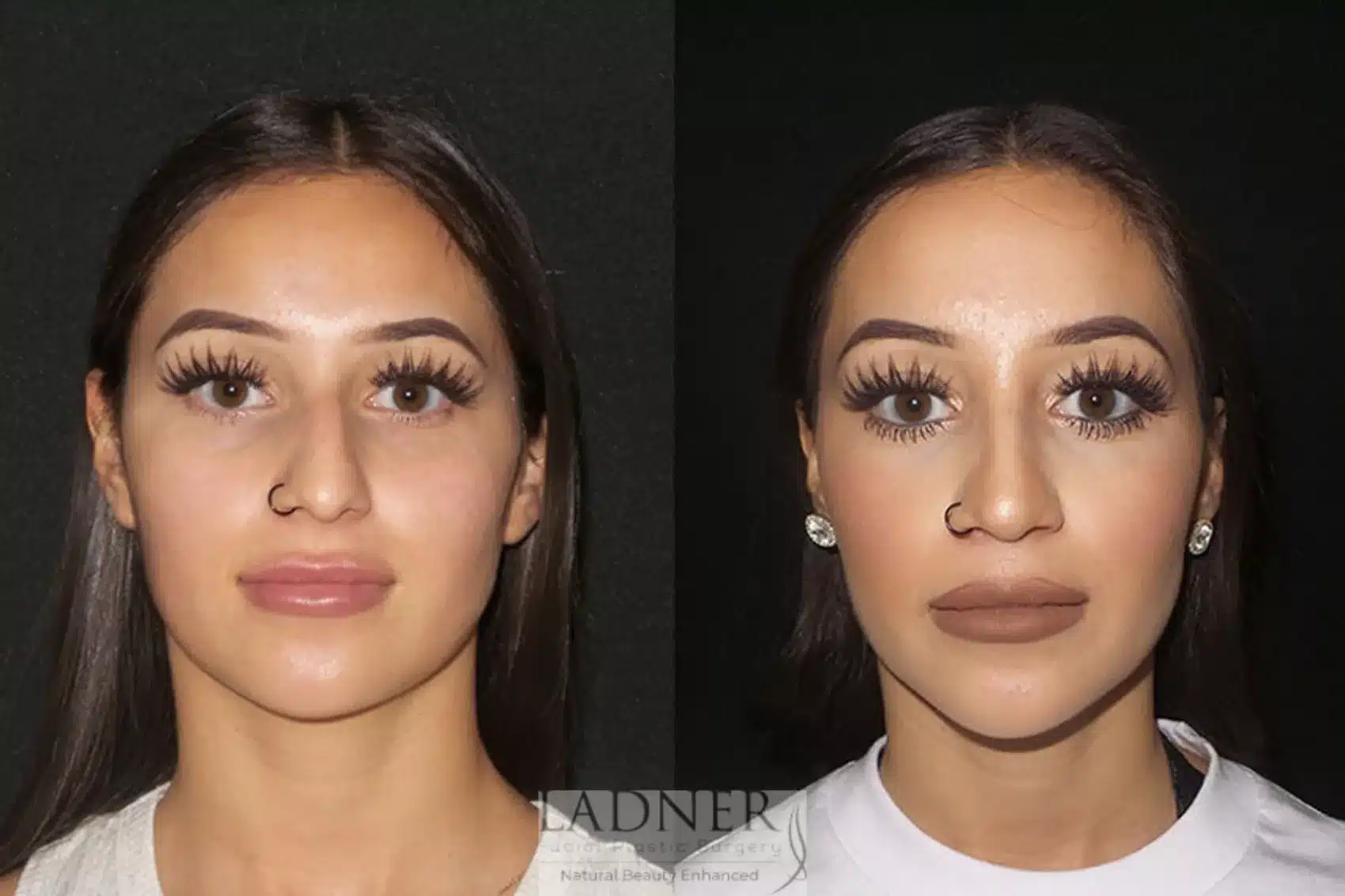 Before and After Image: Rhinoplasty - front