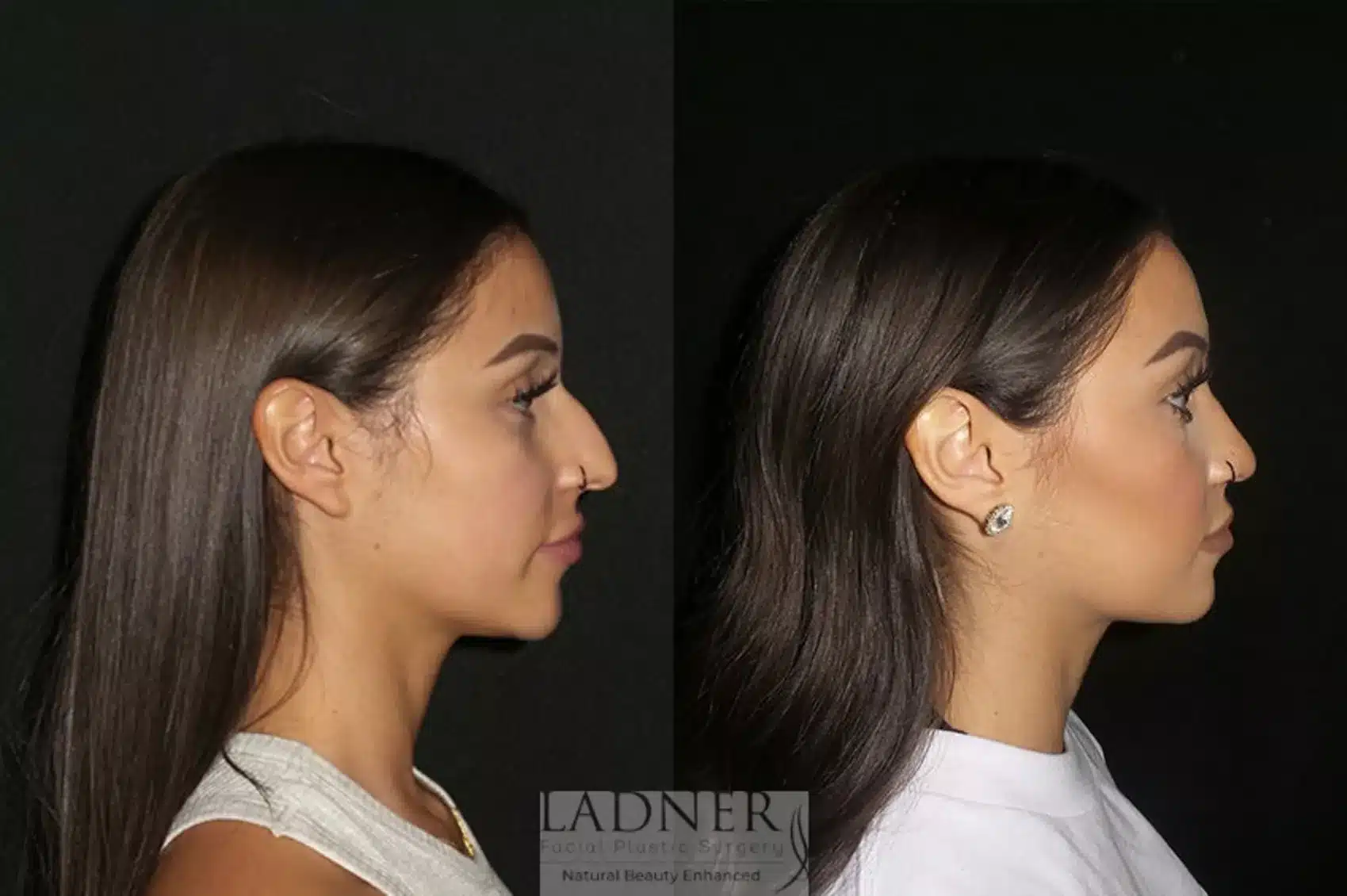 Before and After Image: Rhinoplasty - right-side
