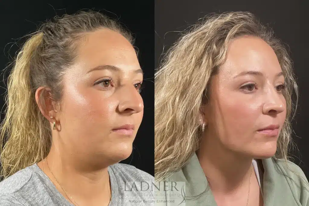 Before and After Image: Minimally Invasive Neck Tightening & Rhinoplasty - right-front-oblique