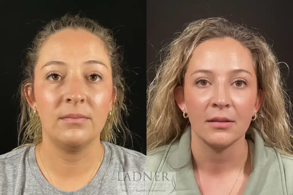 Before and After Image: Minimally Invasive Neck Tightening & Rhinoplasty - front