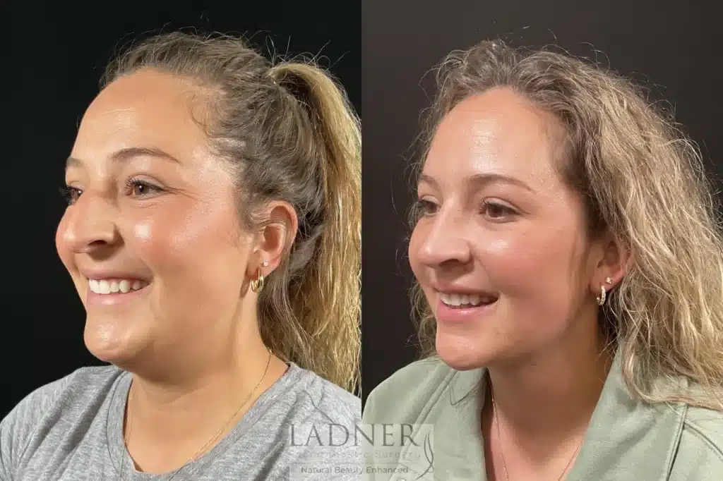 Before and After Image: Minimally Invasive Neck Tightening & Rhinoplasty - left-front-oblique