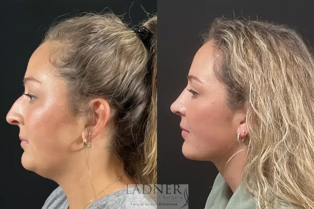 Before and After Image: Minimally Invasive Neck Tightening & Rhinoplasty - left-side