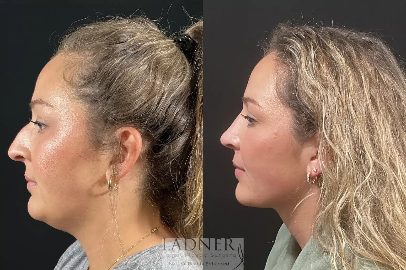 Before and After Image: Minimally Invasive Neck Tightening - left-side