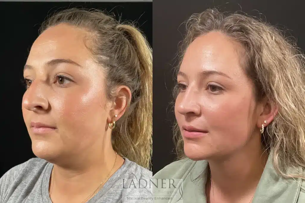 Before and After Image: Minimally Invasive Neck Tightening & Rhinoplasty - left-front-oblique