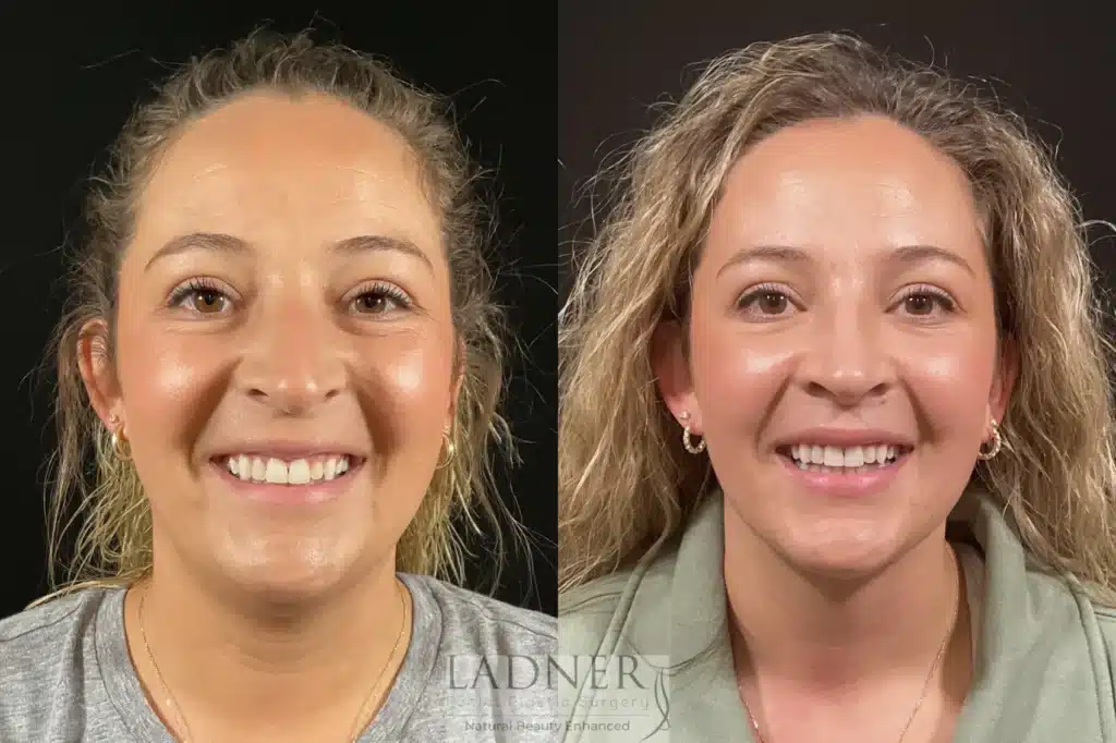 Before and After Image: Minimally Invasive Neck Tightening & Rhinoplasty - front