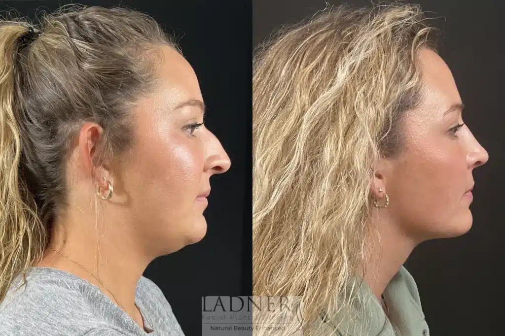 Before and After Image: Minimally Invasive Neck Tightening & Rhinoplasty - right-side