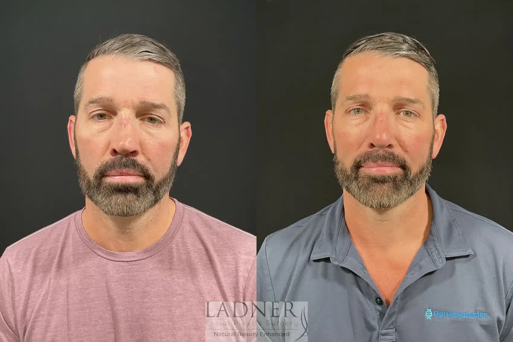 Before and After Image: Rhinoplasty - front