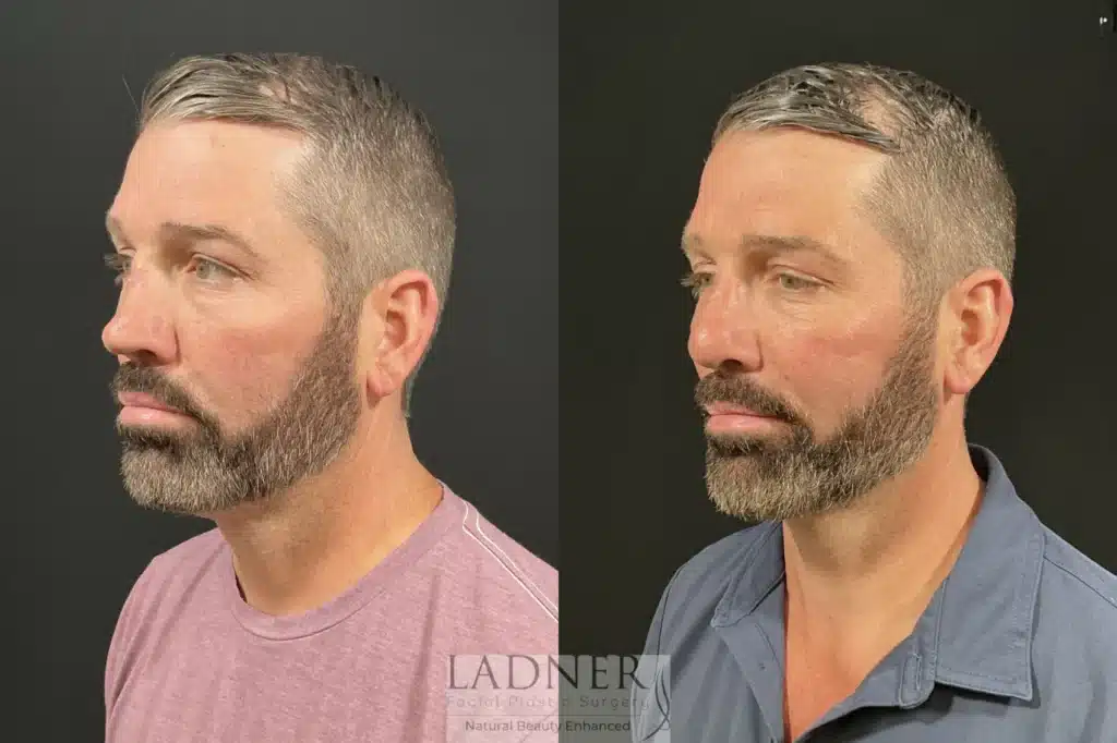 Before and After Image: Rhinoplasty - left-front-oblique