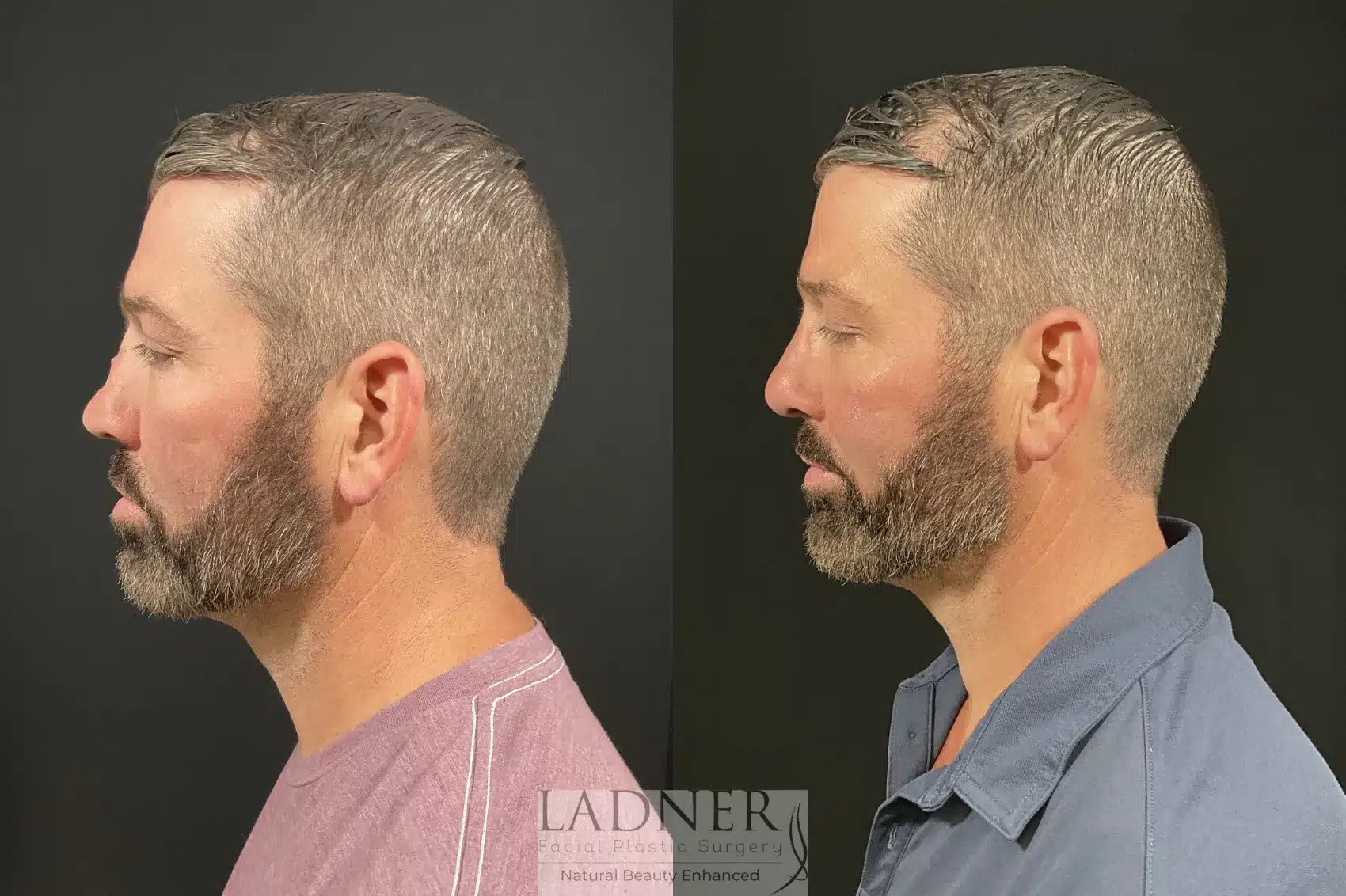 Before and After Image: Rhinoplasty - left-side