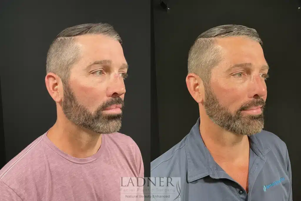 Before and After Image: Rhinoplasty - right-front-oblique