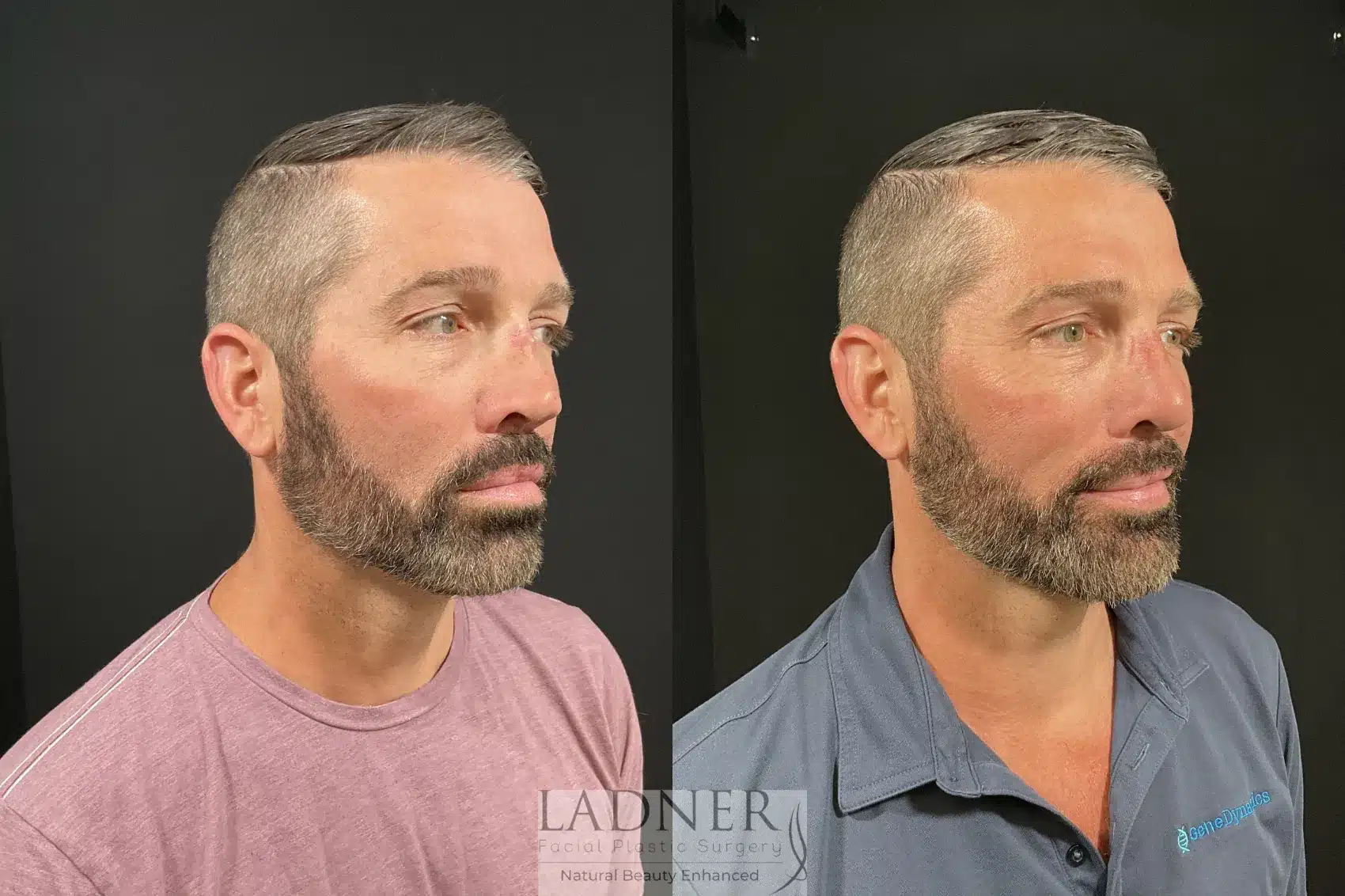 Before and After Image: Rhinoplasty - right-front-oblique