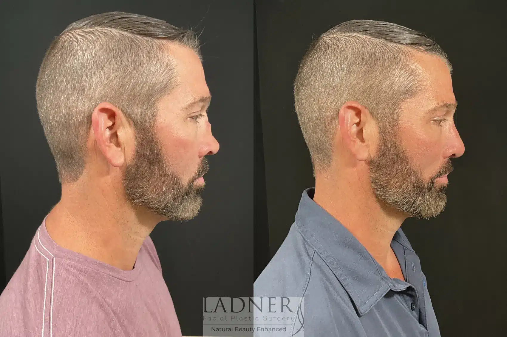 Before and After Image: Rhinoplasty - right-side