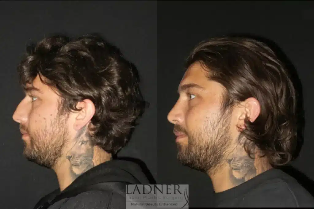 Before and After Image: Rhinoplasty & Facial Plastic Surgery for Men - left-side