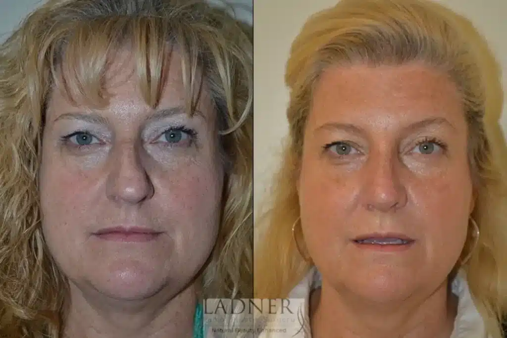 Before and After Image: Rhinoplasty - front