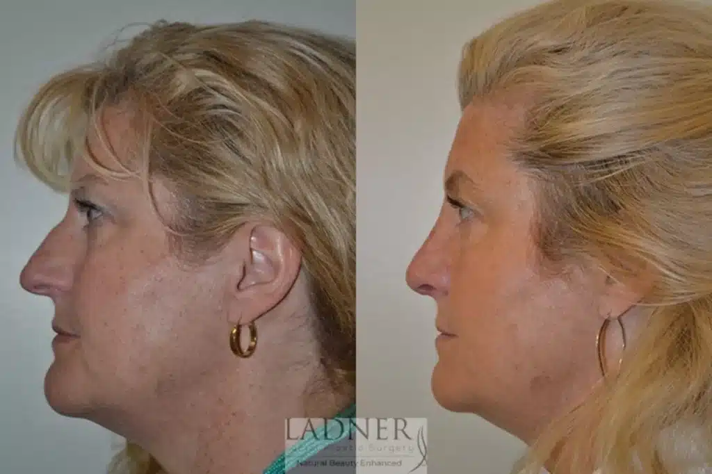 Before and After Image: Rhinoplasty - left-side
