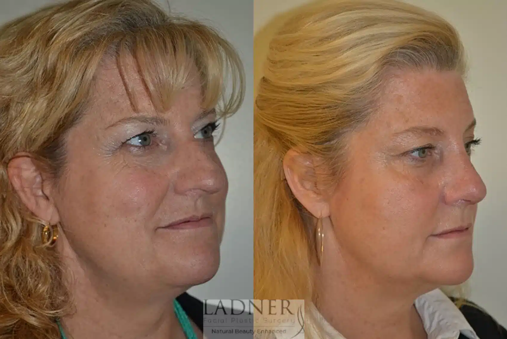 Before and After Image: Rhinoplasty - right-front-oblique