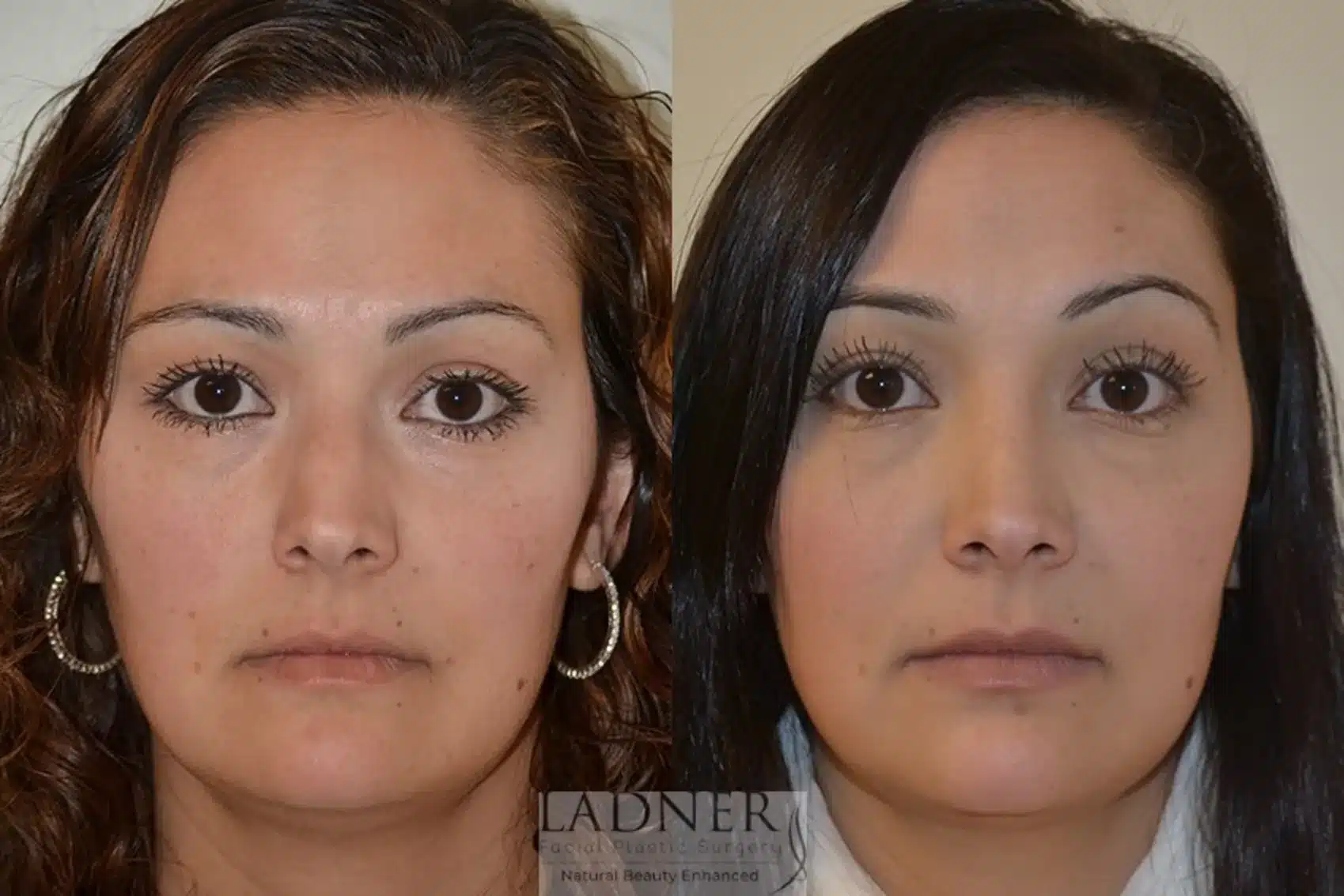 Before and After Image: Rhinoplasty - front