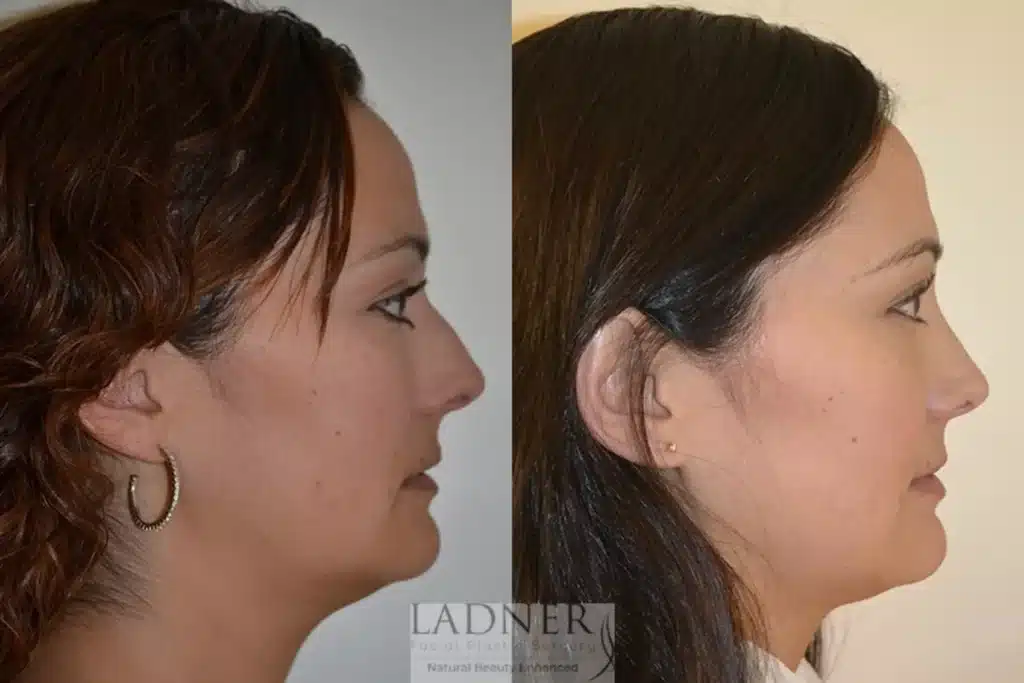 Before and After Image: Rhinoplasty - right-side