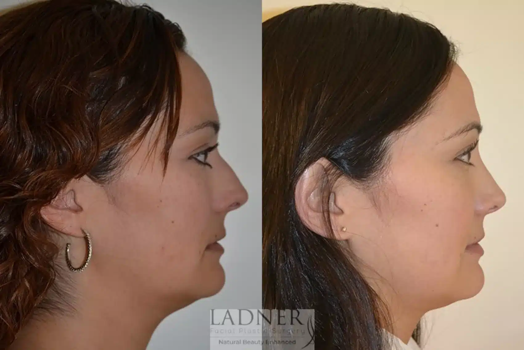 Before and After Image: Rhinoplasty - right-side