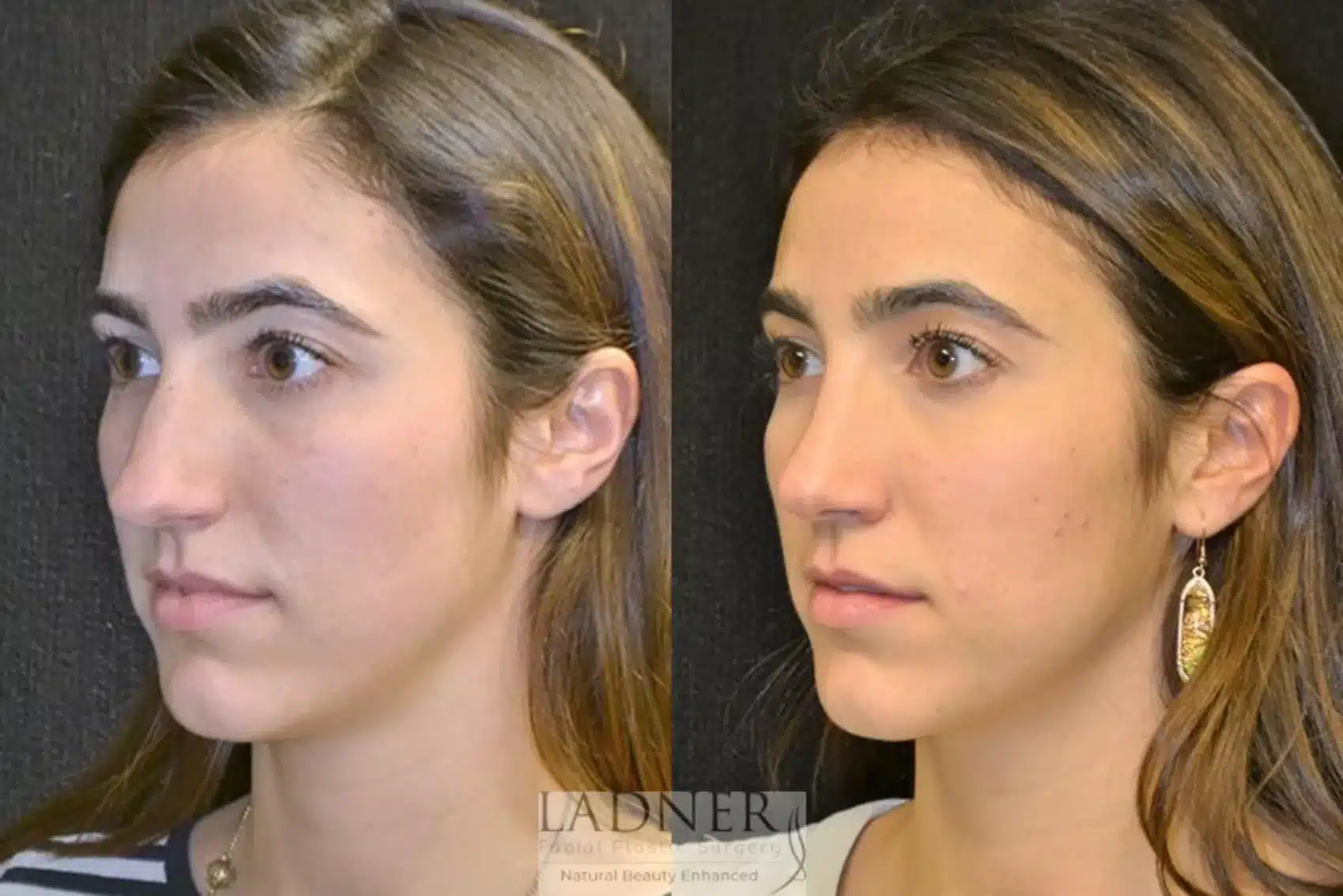 Before and After Image: Rhinoplasty - left-front-oblique