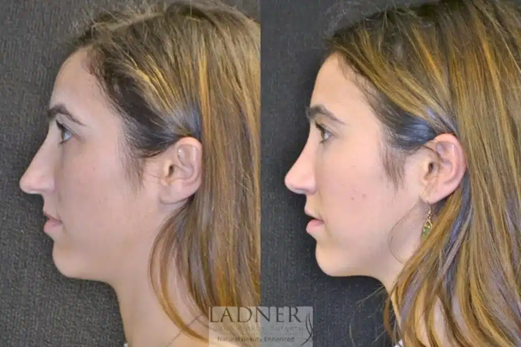 Before and After Image: Rhinoplasty - left-side