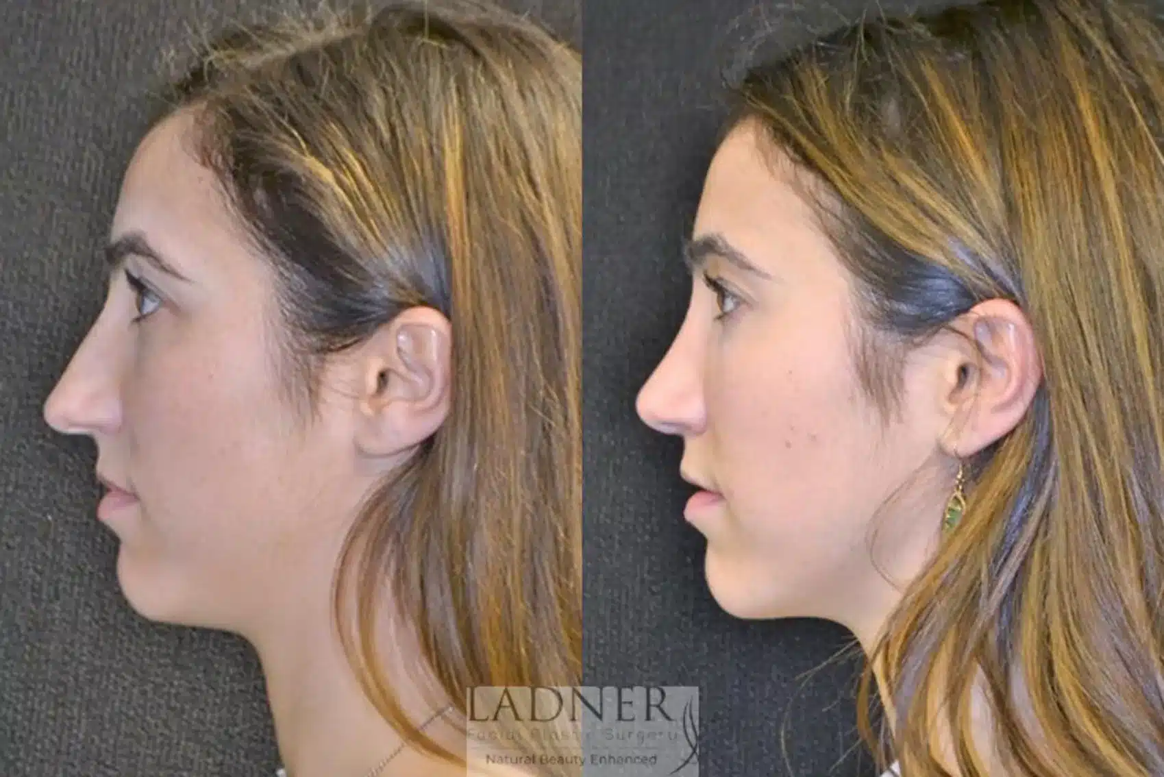Before and After Image: Rhinoplasty - left-side