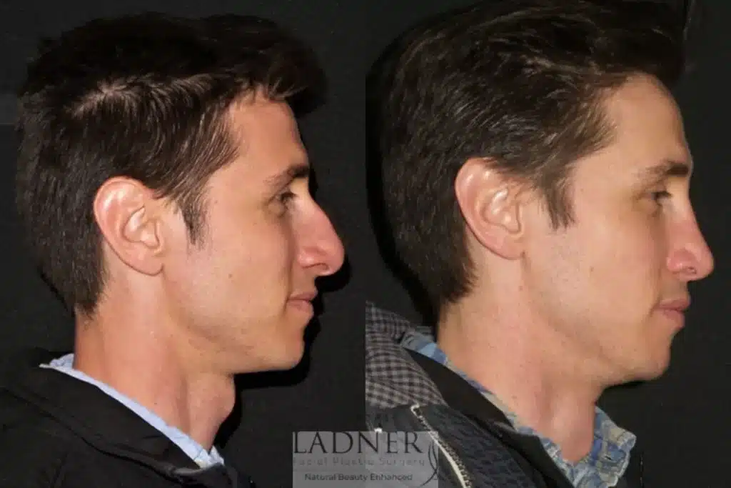 Before and After Image: Rhinoplasty & Facial Plastic Surgery for Men - right-side
