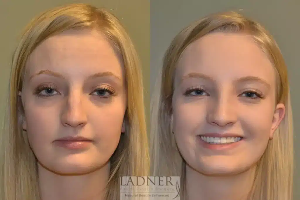 Before and After Image: Rhinoplasty - front