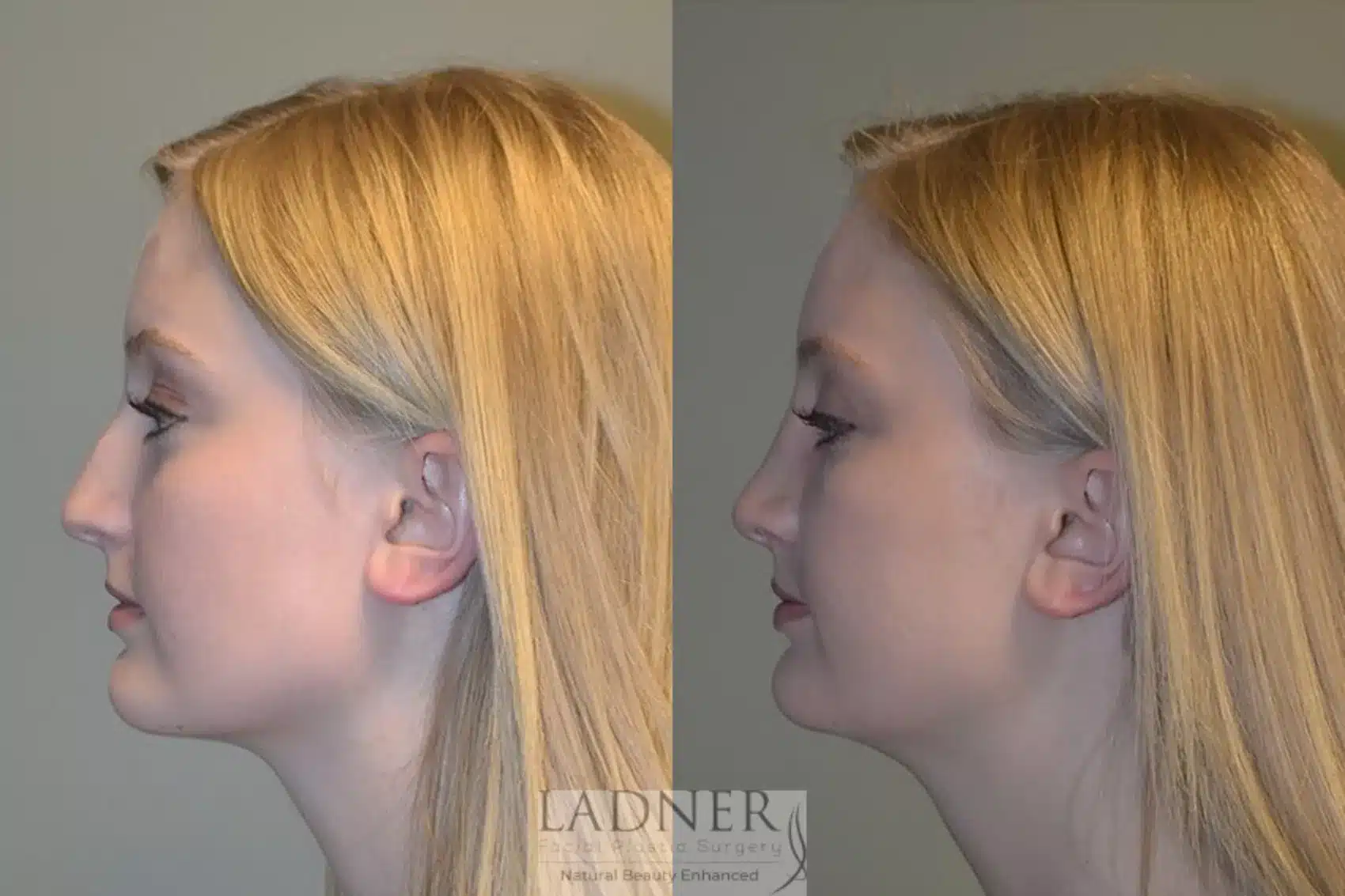 Before and After Image: Rhinoplasty - left-side