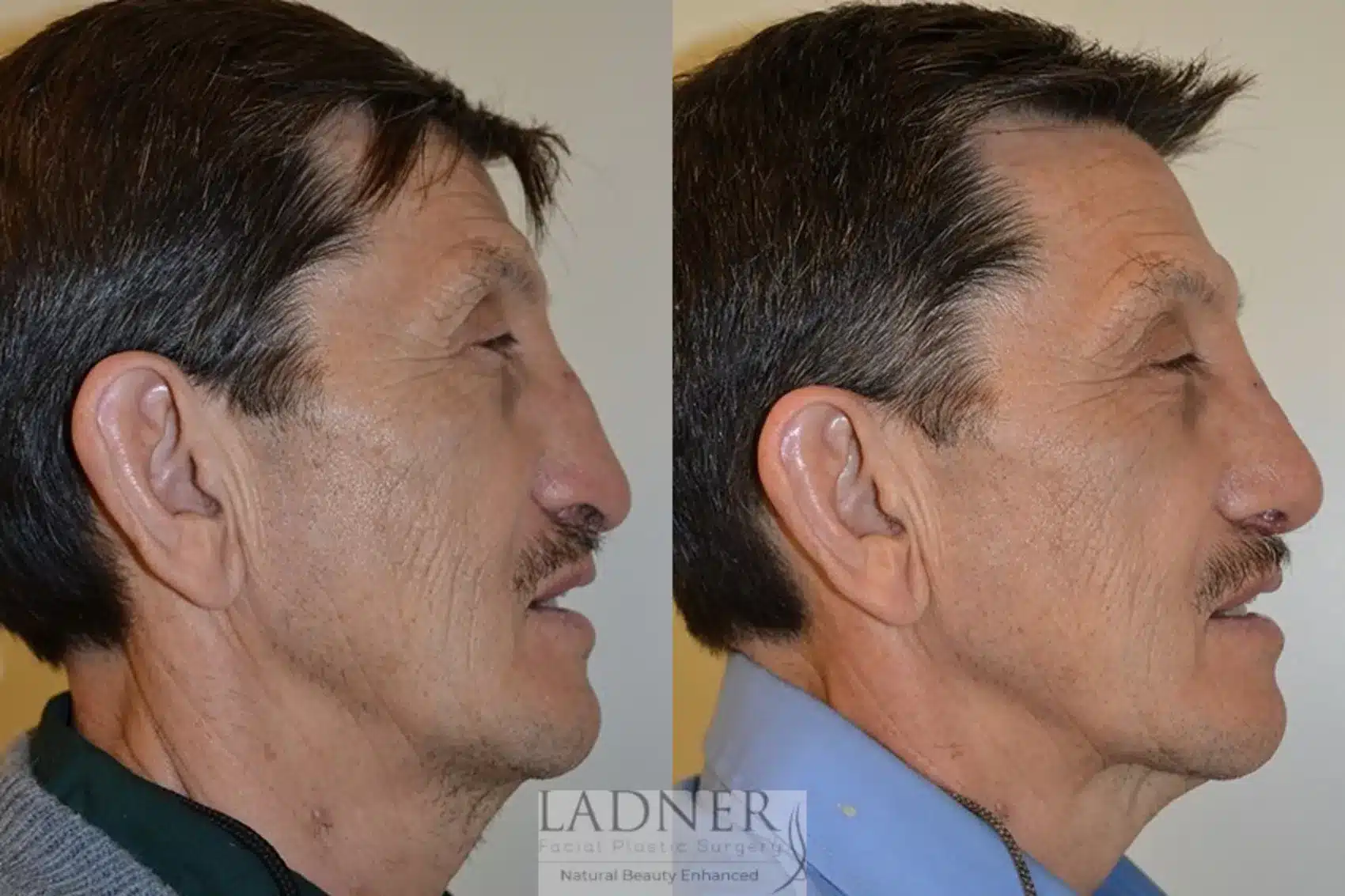 Before and After Image: Rhinoplasty - right-side