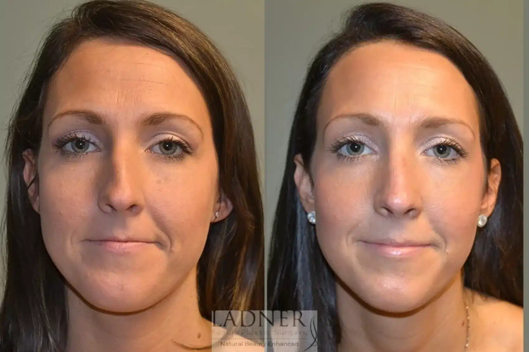 Before and After Image: Rhinoplasty - front