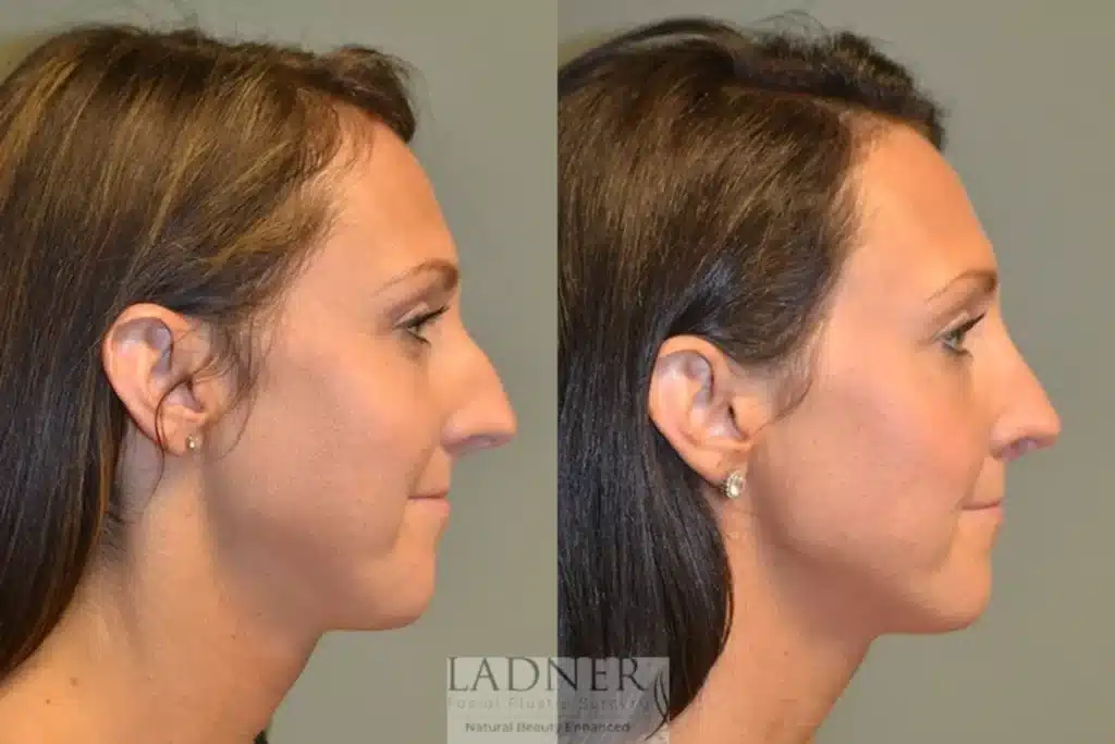 Before and After Image: Rhinoplasty - right-side