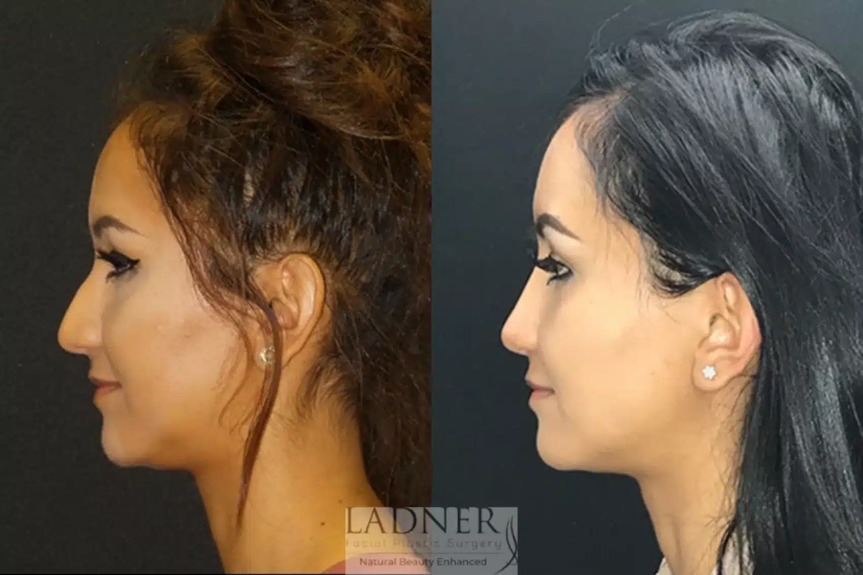 Before and After Image: Rhinoplasty - left-side