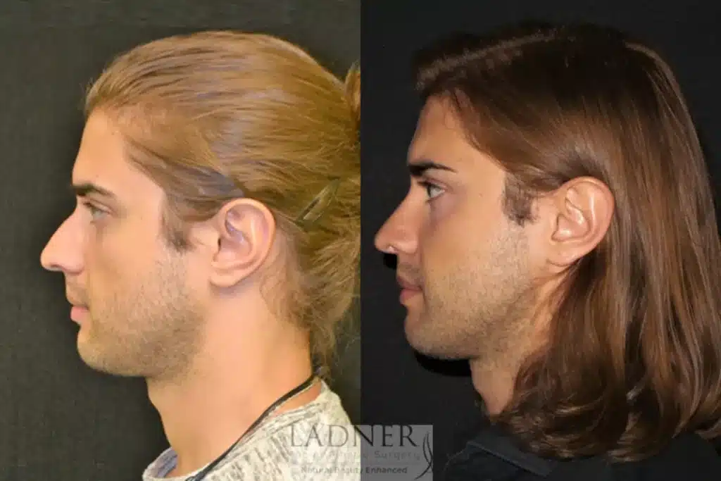 Before and After Image: Rhinoplasty & Facial Plastic Surgery for Men - left-side
