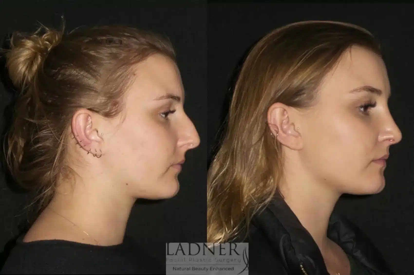 Before and After Image: Rhinoplasty - right-side