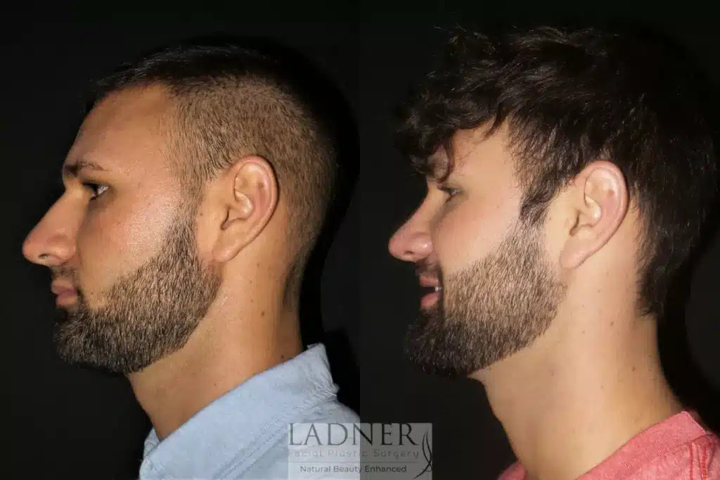 Before and After Image: Rhinoplasty & Facial Plastic Surgery for Men - left-side