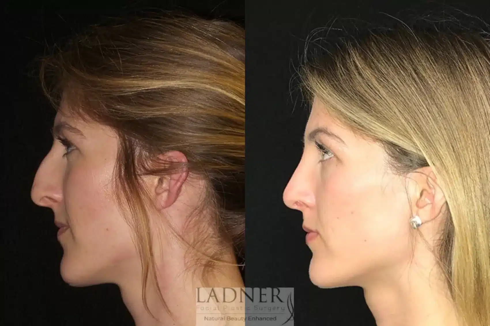 Before and After Image: Rhinoplasty - left-side