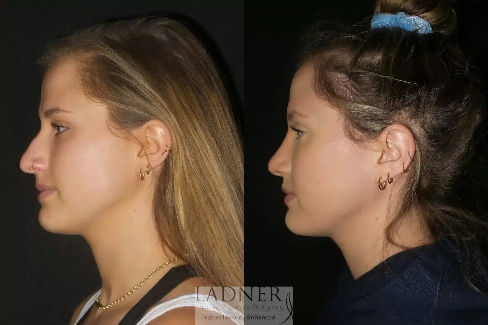 Before and After Image: Rhinoplasty - left-side