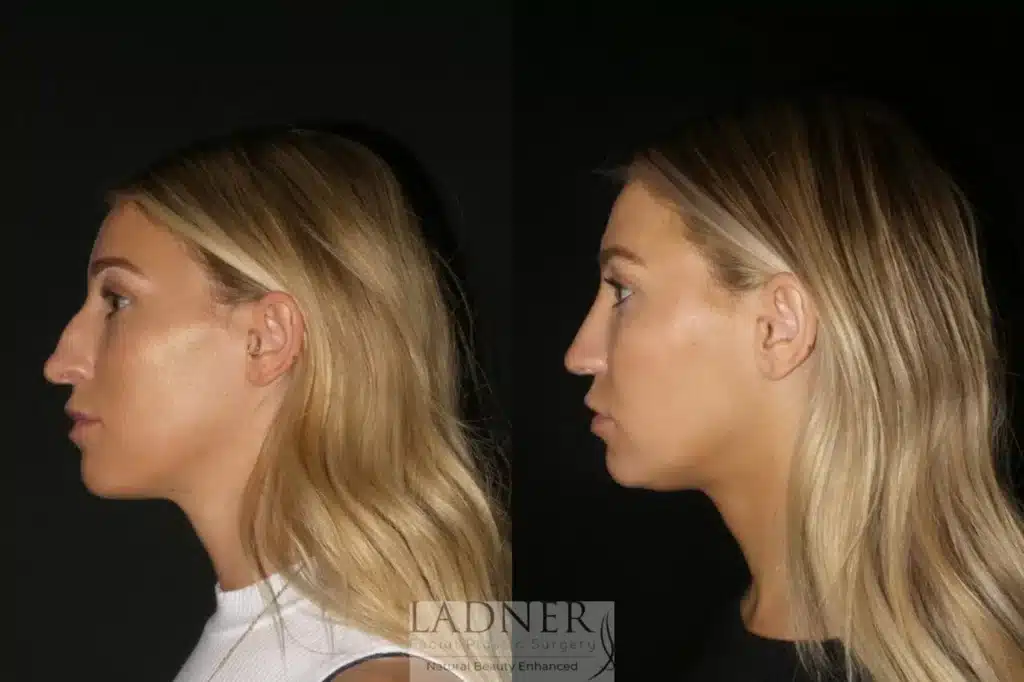 Before and After Image: Rhinoplasty - left-side