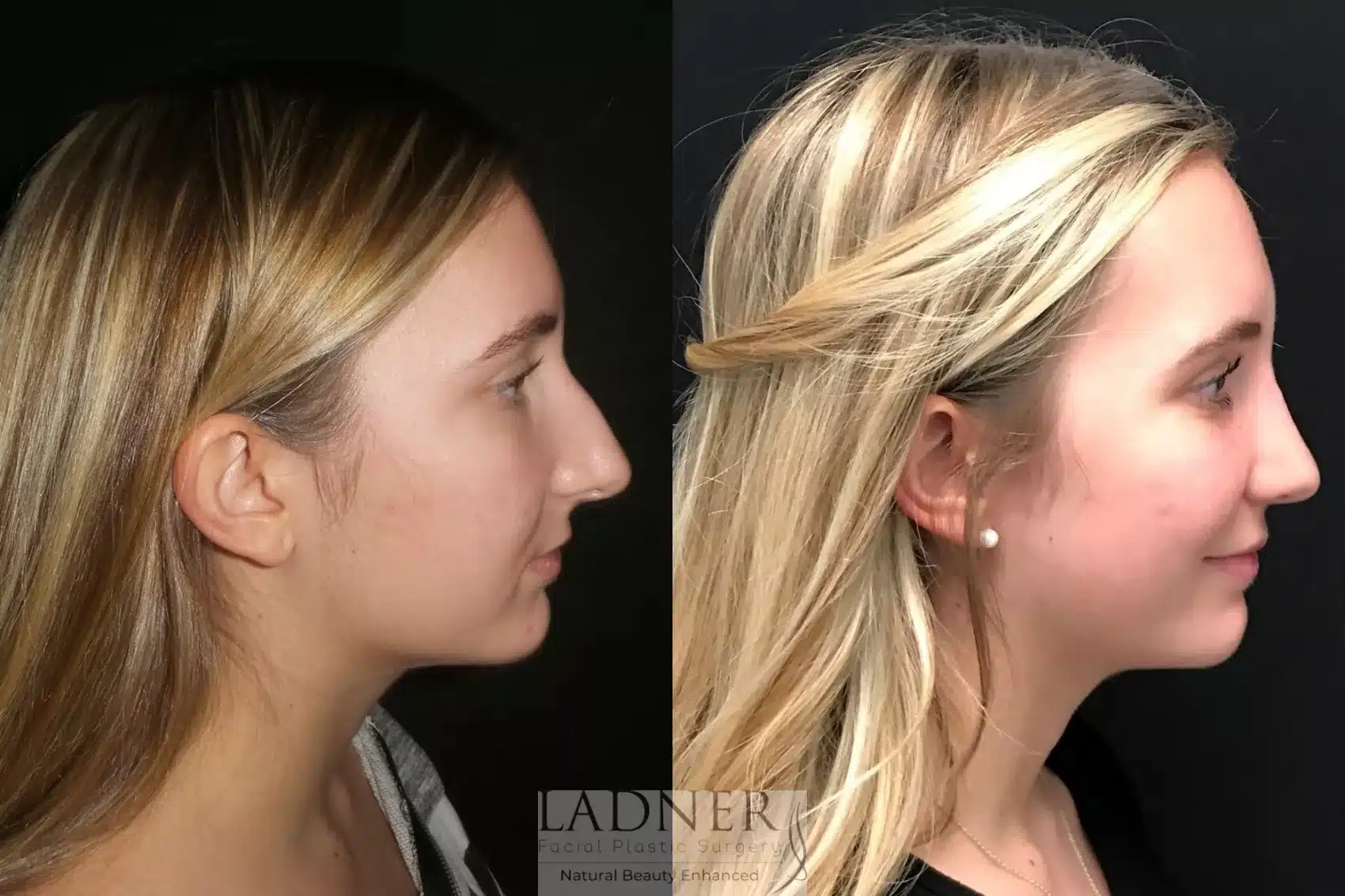 Before and After Image: Rhinoplasty - right-side