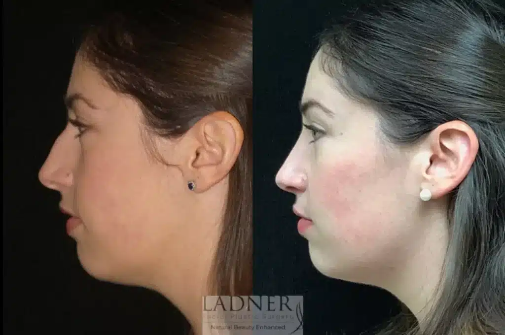 Before and After Image: Rhinoplasty - left-side