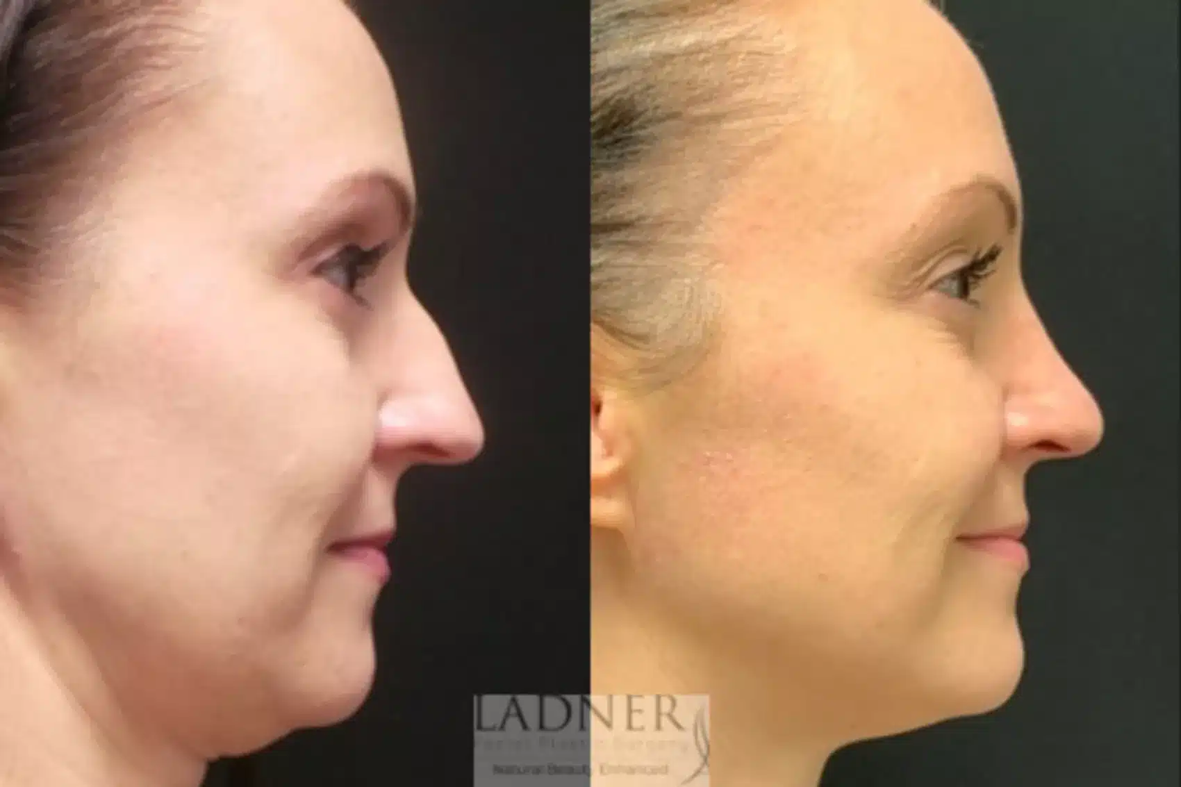 Before and After Image: Rhinoplasty - right-side
