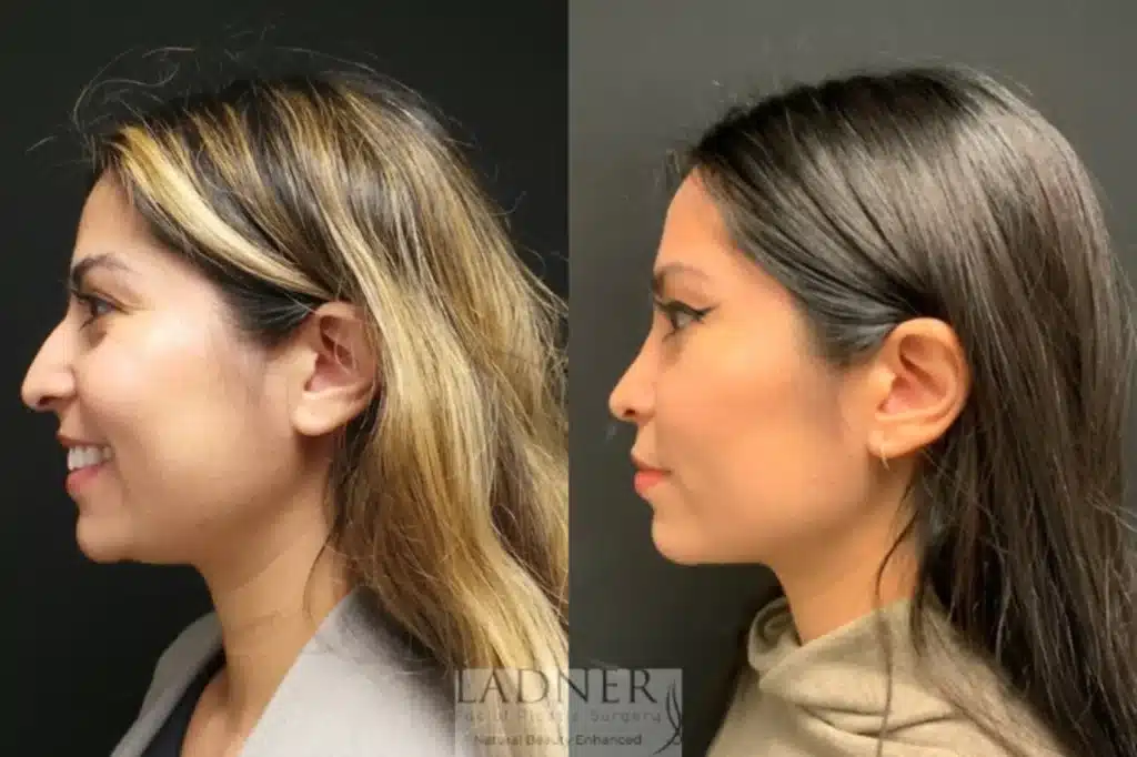 Before and After Image: Rhinoplasty - left-side