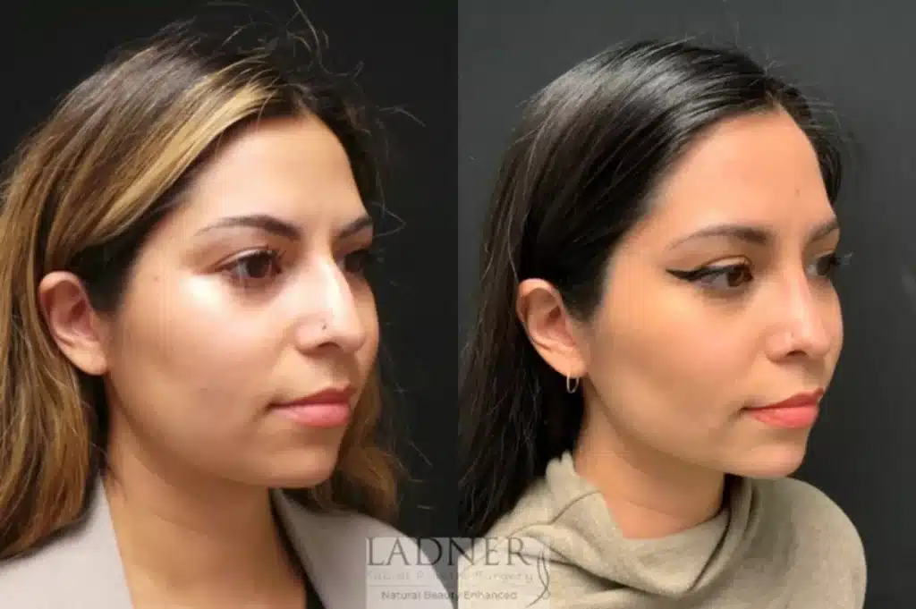 Before and After Image: Rhinoplasty - right-front-oblique